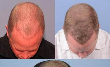 Hair transplantation surgery before and after photos