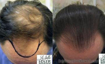 Hair restoration procedure before and after results