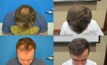 Before and after hair transplant procedure images