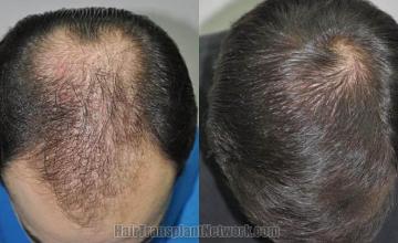 Top view before and after hair restoration results