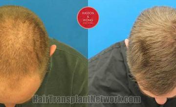 Hair transplantation surgery before and after photos