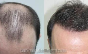 Hair restoration procedure before and after results