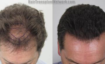 Hair restoration procedure before and after results