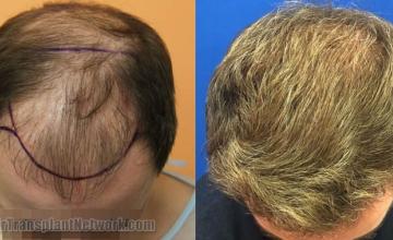 Hair transplantation surgery before and after images