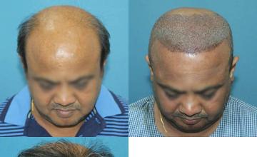 Before and after hair restoration procedure images