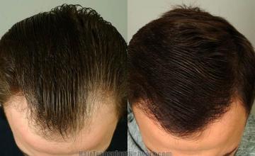 Hair transplantation surgery before and after images