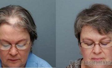 Female hair restoration patient - Front results