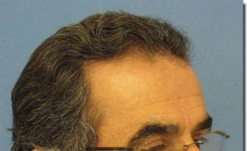 Hair restoration procedure results