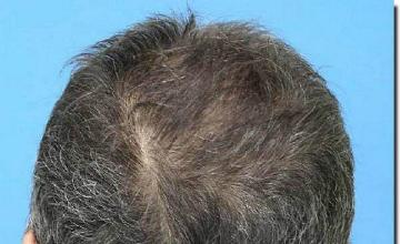 Hair restoration procedure results