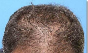 Hair restoration procedure results