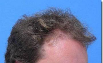 Hair restoration procedure results