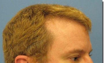 Hair restoration procedure results