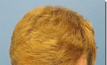 Hair restoration procedure results