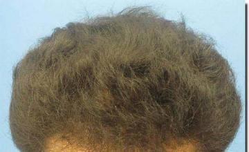 Hair restoration procedure results