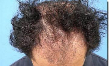 Hair restoration procedure results