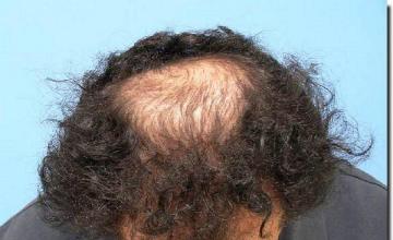 Hair restoration procedure results