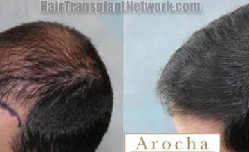 Hair transplantation surgery before and after images