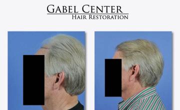 Hair restoration procedure before and after results