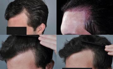 Hair transplantation surgery before and after photos