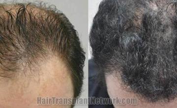 Top view - Before and after surgical hair replacement