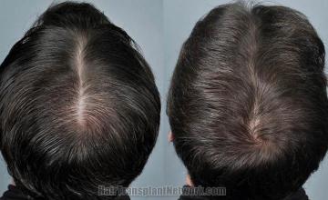Hair transplantation surgery before and after images