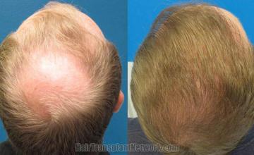 Hair restoration procedure before and after pictures