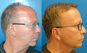 Hair transplantation surgery before and after images