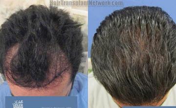 Hair transplantation surgery before and after photos