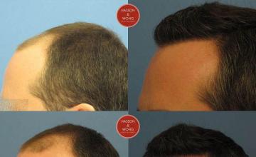 Hair transplantation surgery before and after pictures