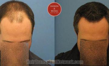 Hair transplantation surgery before and after photos