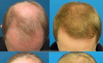 Hair transplantation surgery before and after photos