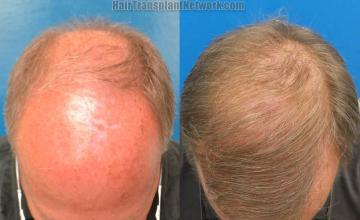 Top view before and after hair restoration results