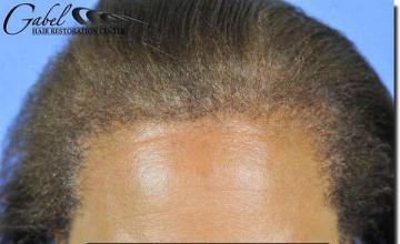 Hair restoration procedure results