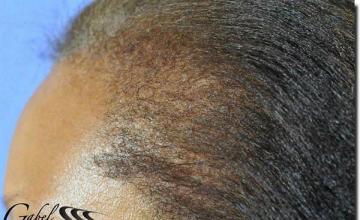 Hair restoration procedure results