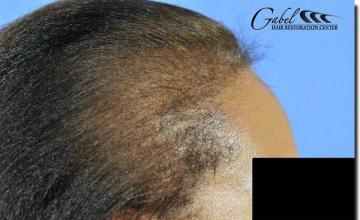 Hair restoration procedure results