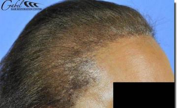 Hair restoration procedure results