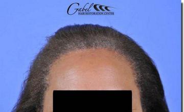 Hair restoration procedure results