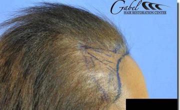 Hair restoration procedure results