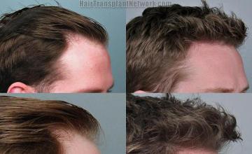 Hair restoration procedure before and after results