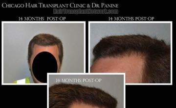 Hair transplantation surgery before and after photos