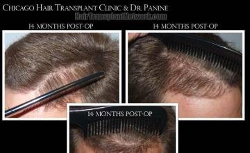 Hair transplantation surgery before and after pictures