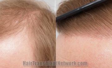 Hair restoration procedure before and after pictures