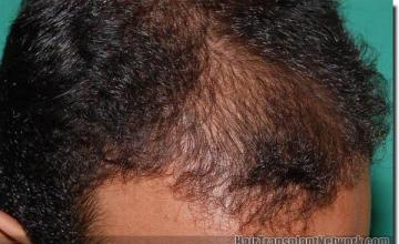 Hair restoration procedure results