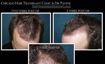 Hair restoration surgery before and after images