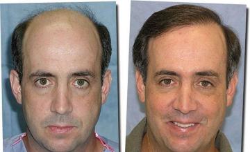 Hair restoration procedure results