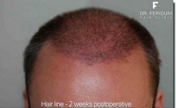 Hair restoration procedure results