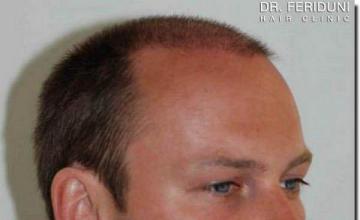 Hair restoration procedure results