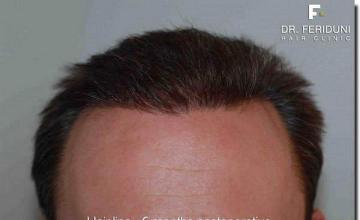 Hair restoration procedure results