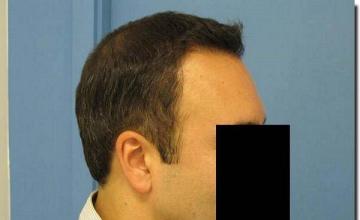 Hair restoration procedure results