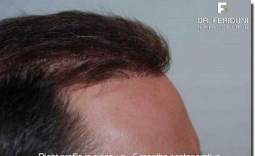 Hair restoration procedure results